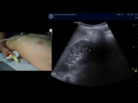 Sonographie der linken Niere