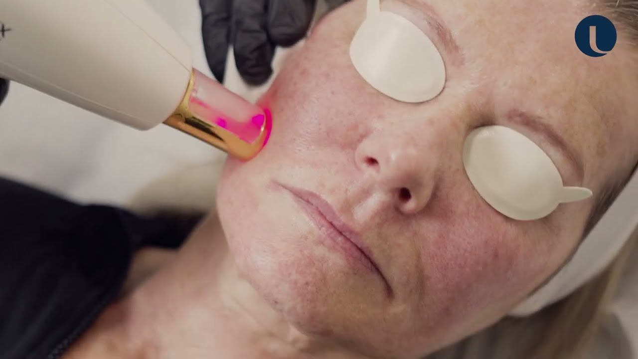 ResurFX Fractional Resurfacing procedure video