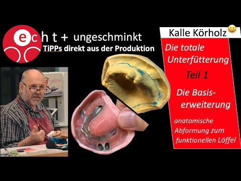 Unterfütterung/Basiserweiterung -1. Teil - mit Teleskop-Prothese