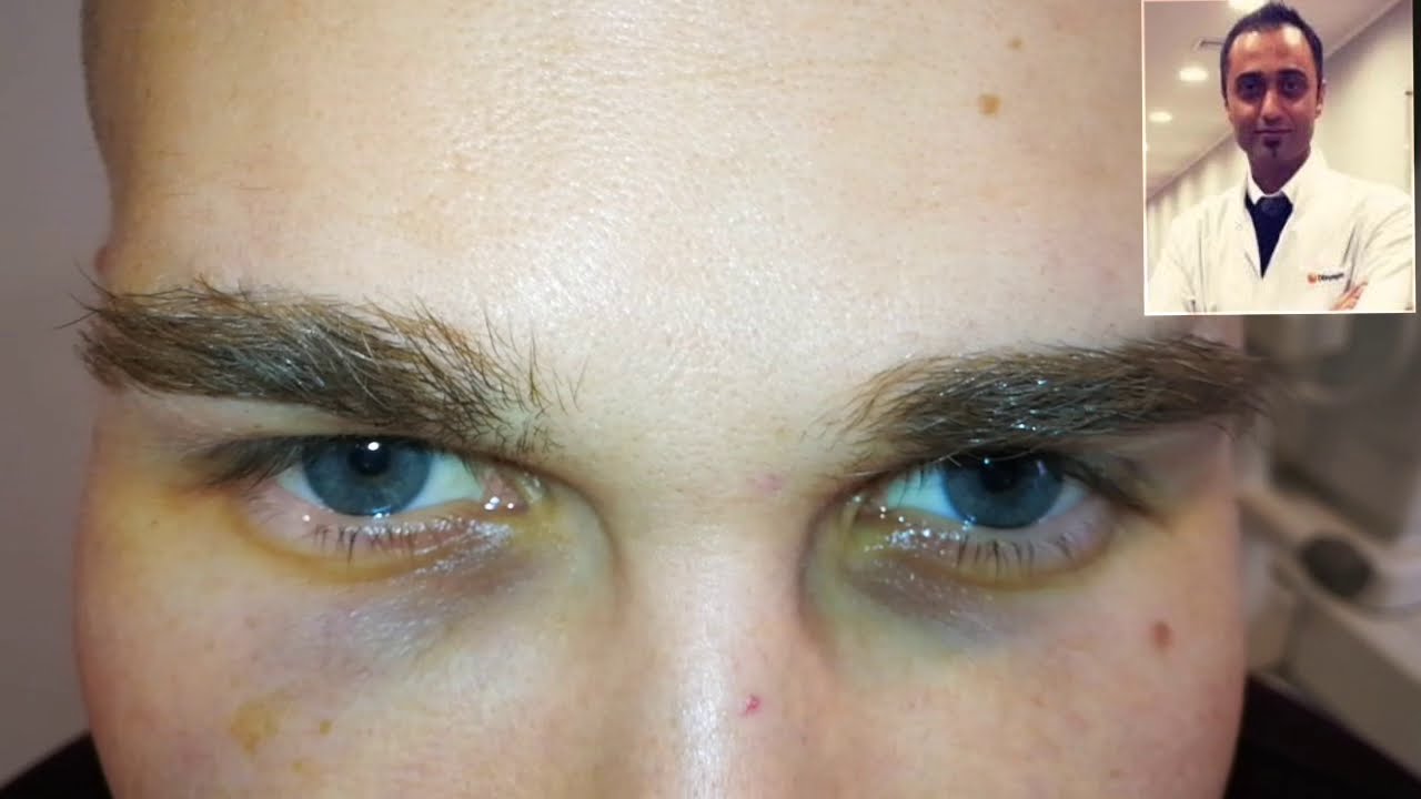 Lumineyes Augenfarbänderung mit Laser Türkei
