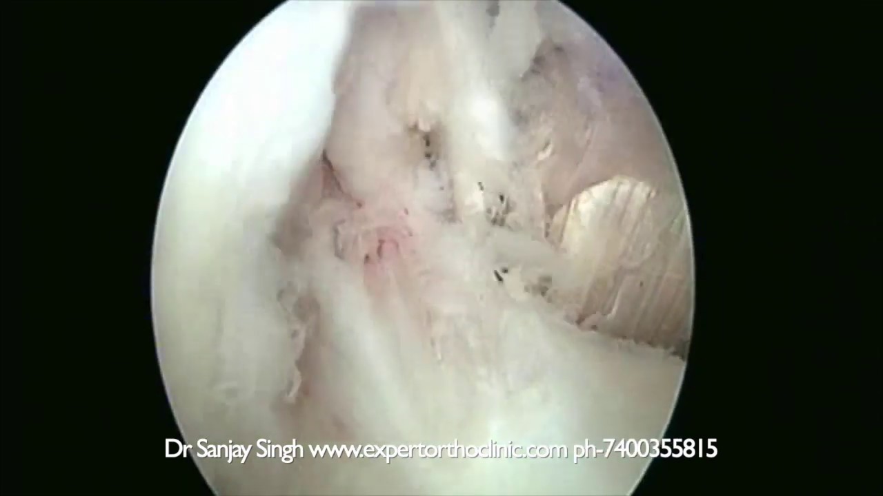 Arthroscopic PCL Reconstruction Surgery