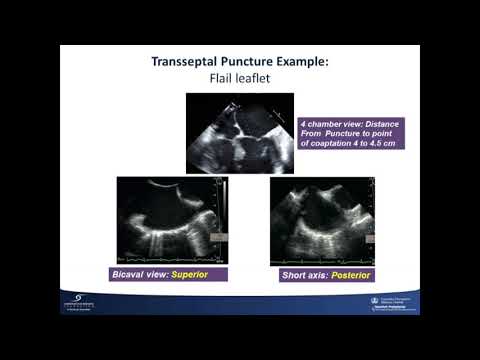 Course 13: Percutaneous Transseptal Access, TMVR, & Mitral Valve-in-Valve Replacement