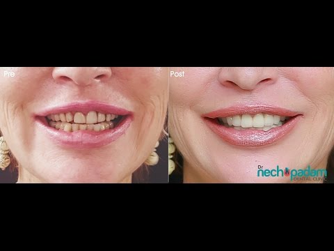 Dental Tourism India American tourist @ Kerala- onial of a Hollywood actress/ model