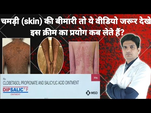 Memosalic Clobetasol Propionate Salicylic Acid Ointment