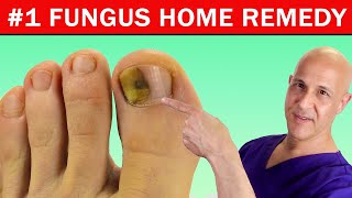 #1 Best Home Remedy Cure for Toenail Fungus!  Dr. Mandell