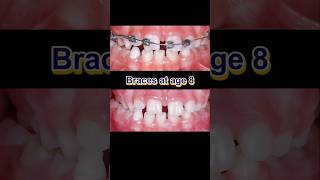 Download lagu Braces at age 8. Fix gapped teeth #braces #dentist #orthodontist mp3
