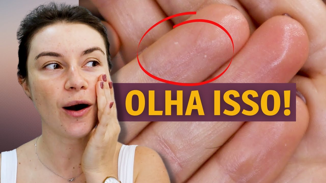 Como tirar cravos em casa | Dica de Esteticista