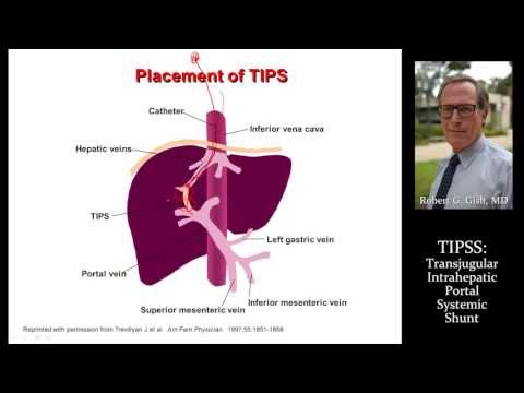 TIPSS (transjugular intrahepatic portosystemic shunt) by Dr. Robert Gish