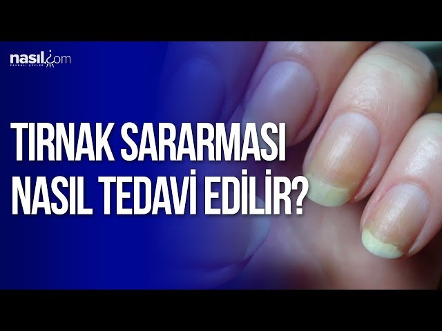 tirnak sararmasini geciren 5 dogal cozum nefis yemek tarifleri