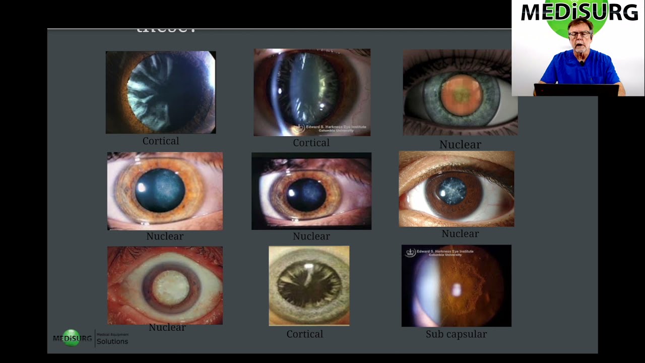 Cataract Presentation
