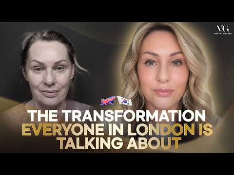 Sharon’s Deep Plane Facelift Recovery at VG Plastic Surgery Seoul