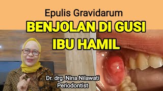 Download lagu EPULIS GRAVIDARUM: Benjolan di gusi ibu hamil mp3 Download lagu EPULIS GRAVIDARUM: Benjolan di gusi ibu hamil mp3