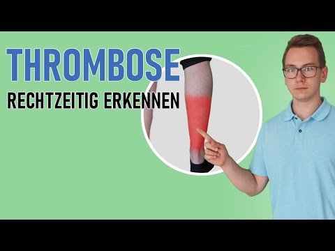 Thrombosis: Do I have thrombosis? Recognizing symptoms and signs