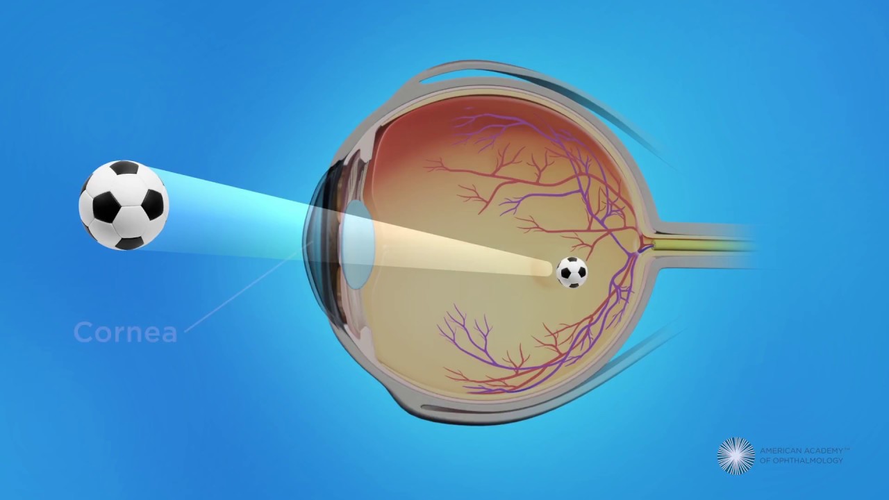 CPC for Glaucoma Treatment
