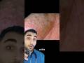 If You See This You Have Dyshidrotic Eczema!! 🤯🤯 (Doctor Explains)