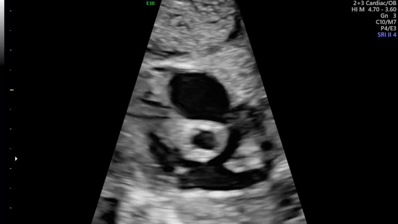 AVALIAÇAO DE AORTA FETAL ECOCARDIO FETAL