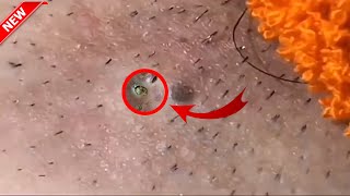 Blackheads Removal | Acne Treatment and Very Satisfying Satisfying Pimple pop  #blackheads