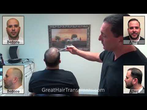 Dr. Brett Bolton Patient Adrien MaxHarvest &trade; Plus - 3 Months Follow up
