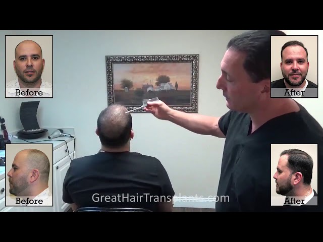 Dr. Brett Bolton Patient Adrien MaxHarvest &trade; Plus - 3 Months Follow up
