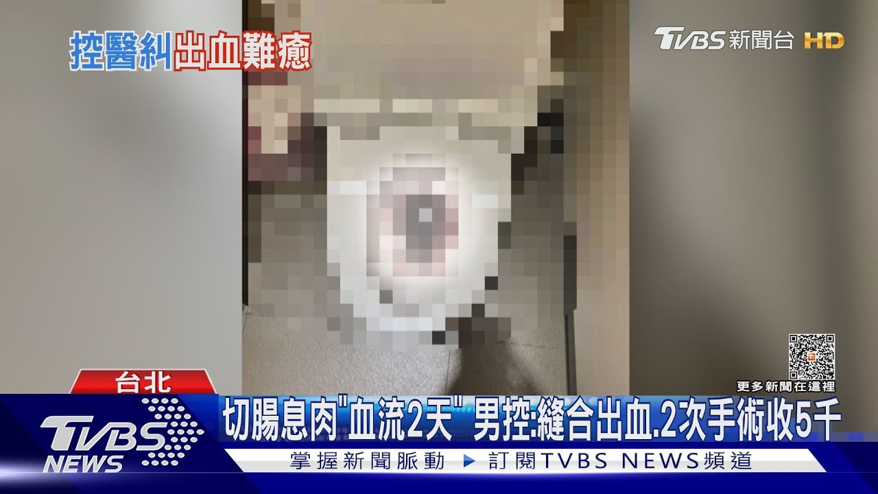 切腸息肉「血流2天」 男控:縫合出血2次手術收5千