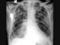 chest x-ray interpretation, pulmonary edema part 2 ...