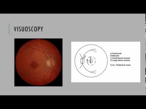 Visuoscopy (Fixation Ophthalmoscopy)