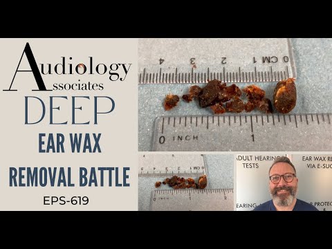 DEEP EAR WAX REMOVAL BATTLE - EP619