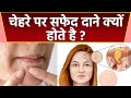 चेहरे पर सफ़ेद दाने क्यों होते है चेहर