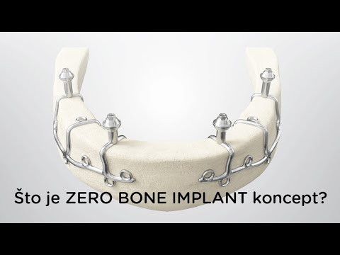 Što je ZERO BONE IMPLANT koncept?