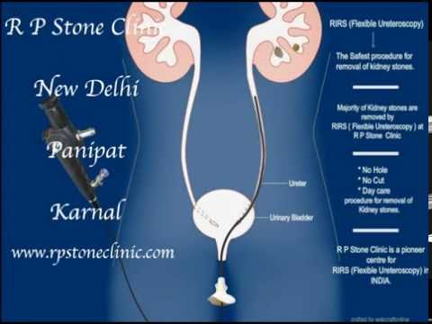 Animation of Kidney stone treatment by RIRS/ Flexible Ureteroscopy