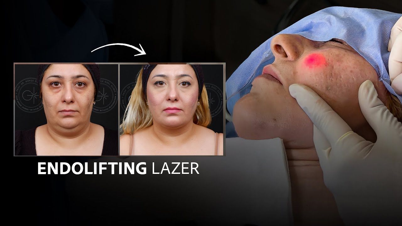 CERRAHİSİZ GENÇLEŞMEDE İLERİ TEKNOLOJİ I ENDOLIFTING LAZER #yüzgençleştirme #endolift