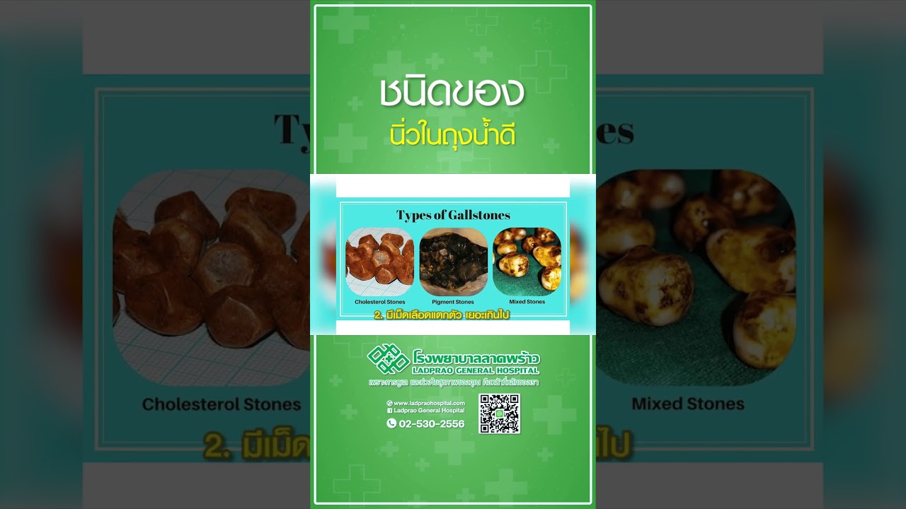 ชนิดของนิ่วในถุงน้ำดี #นิ่วในถุงน้ำดี #โรงพยาบาลลาดพร้าว