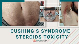 Cushing syndrome #prednisone side effects #corticosteroids