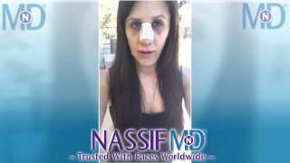 Vlog of My Revision Rhinoplasty - Alyssa | Dr. Paul Nassif