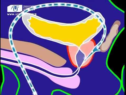 comment soigner adenome prostate