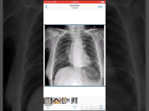 Case 037 Massive pneumoperitoneum
