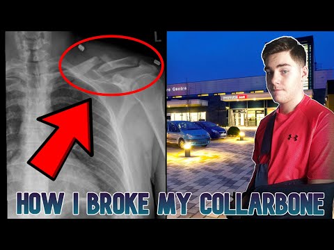 How i broke my collarbone.....