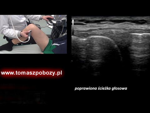 USG kolana – badanie stawu kolanowego krok po kroku | ortopeda