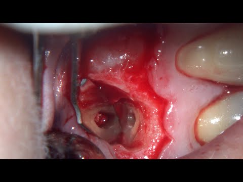 Apical surgery with biopsy in a case of failed retreatment. Domenico Ricucci.