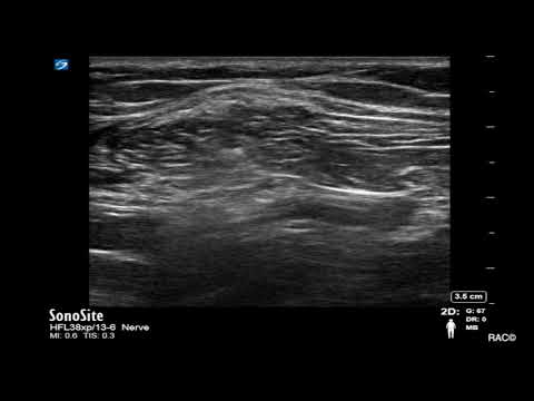 Ultrasound Guided Popliteal Sciatic Nerve Blockade with Catheter Placement