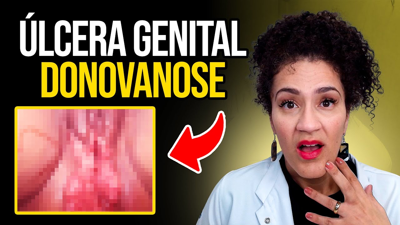 Úlcera Genital - Donovanose ou Granuloma Inguinal