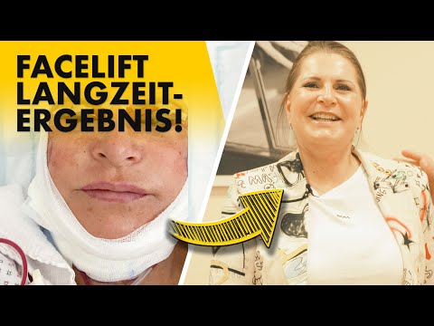 Sie will ihr Fächer-Facelift 1 Jahr nach OP zeigen! | Dr. Jungwirth