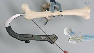 FRNAdvanced Femoral Recon Nailing System