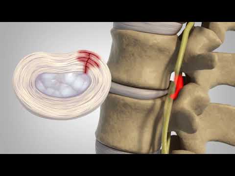 Herniated Disc - Patient Education