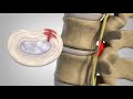 Herniated Disc - Patient Education