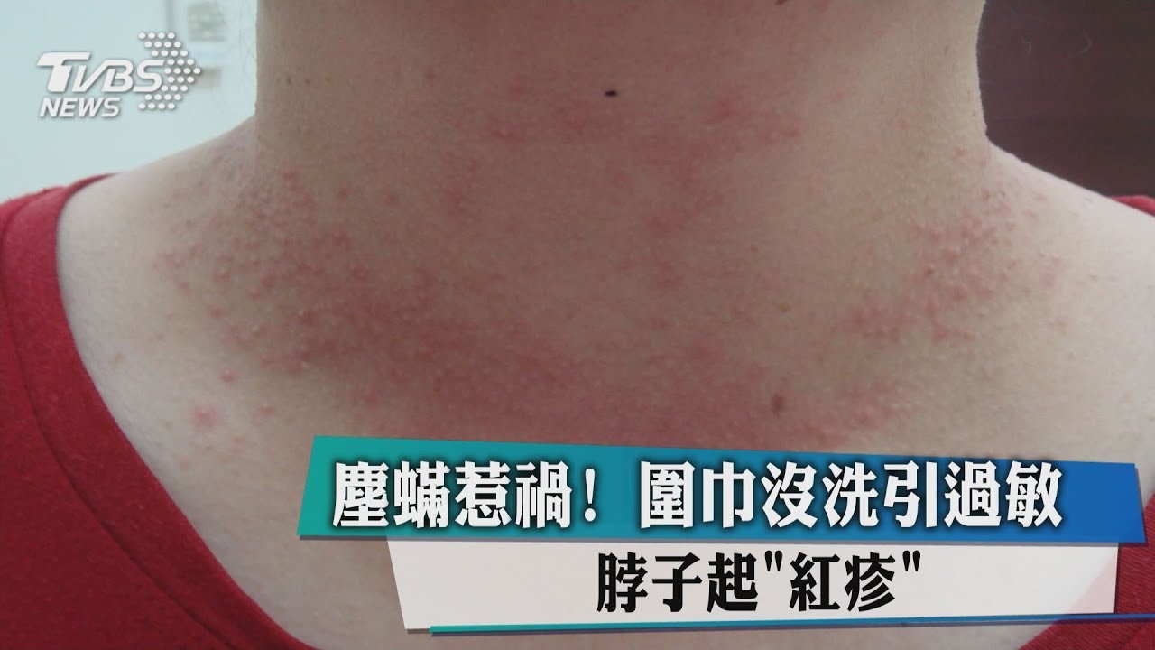 塵蹣惹禍!圍巾沒洗引過敏 脖子起「紅疹」