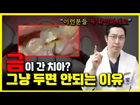 금이 간 치아 (치아크랙)의 원인과 증상, 그리고 치료법