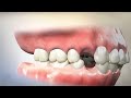 Removing Teeth for Braces - Why  Extracting and Retracting Orthodontics is harmful