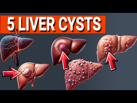 Top 5 Liver Cysts Explained: What You Need to Know!