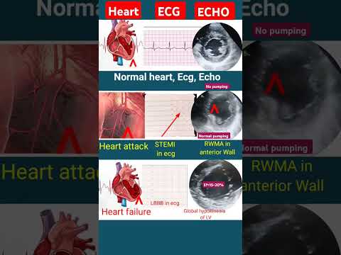 Heart attack v/s Heart fail ecg , echo l #ecg #echo #shorts